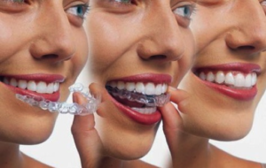 Affordable Invisalign Near Me South Amboy NJ