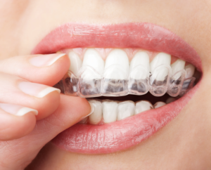 average cost of invisalign perth amboy nj