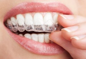 Invisalign Teen in Perth Amboy