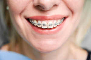 Braces in Perth Amboy NJ: Which Type Works the Fastest?